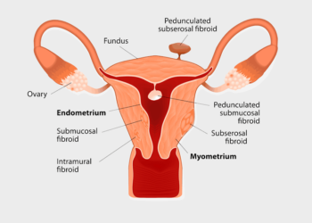 Miyomlar Tüp Bebek Başarısını Olumsuz Etkileyebilir mi?