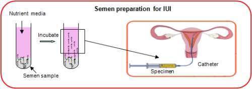 Step by step IUI procedure