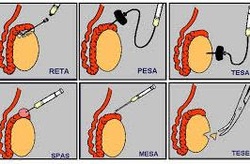 Cerrahi sperm elde etme ve çıkarma yöntemleri TESA, TESE, Mikro Tese, PESA ve MESA'yı içerir.