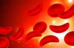 L'anemia falciforme può essere prevenuta attraverso il trattamento di fecondazione in vitro con PGD. 