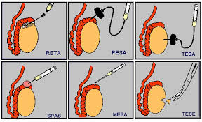 Surgical sperm extraction methods