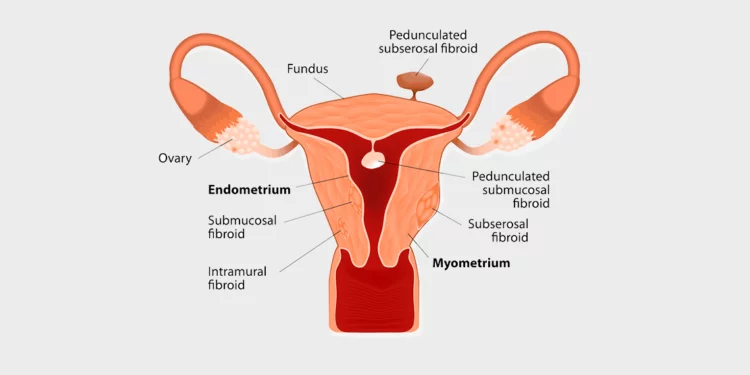 Can fibroids negatively affect IVF Success?